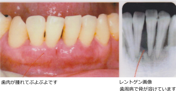 歯肉が腫れてぶよぶよの状態