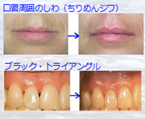 ヒアルロン酸注入療法